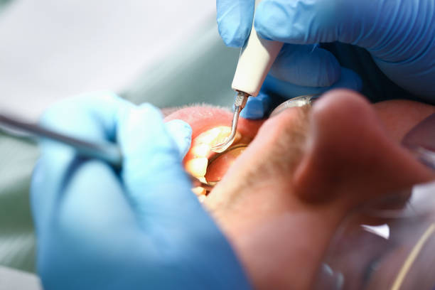 Best Dentist for Tooth Abscess  in White Sulphur Springs, MT